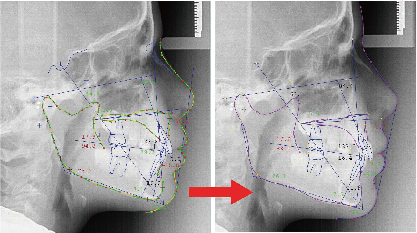 新機能　画像診断システム	セファロ分析